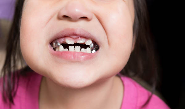 When Does My Child Need A Baby Dental Crown?