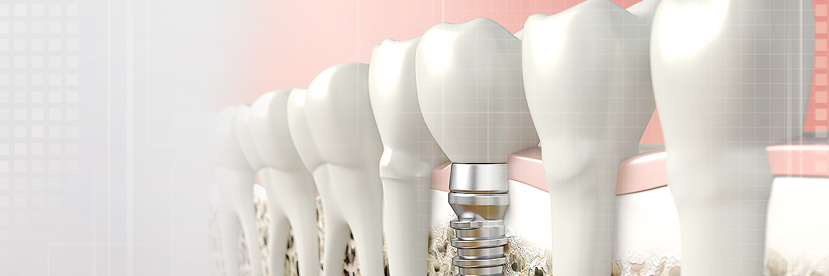 Parker Tooth Colored Fillings